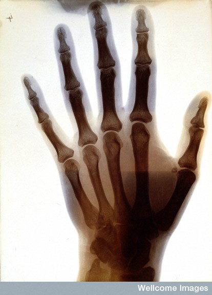 Radiograph of Margaret Glyn's hand