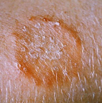 Ringworm on an arm