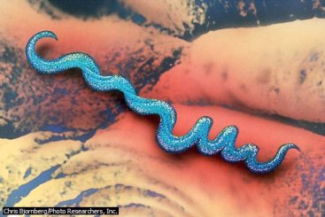 The cause of GPI - spirochaete Treponema pallidum
