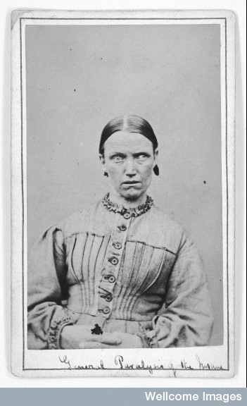 Woman Suffering From General Paralysis of the Insane
